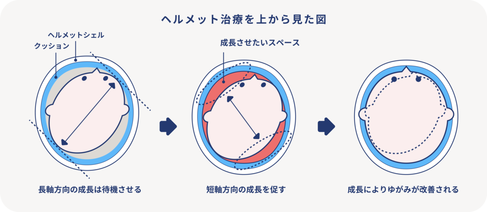 ヘルメット治療について